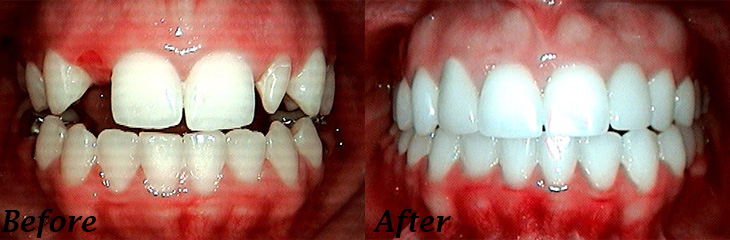 Smile Gallery Before and After