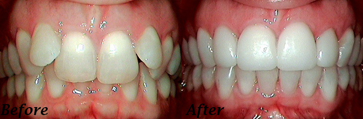 dental before and after from The Leading Dentists in North Royalton, OH