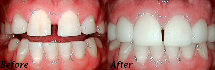 dental before and after from The Leading Dentists in North Royalton, OH