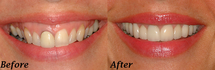 dental before and after from The Leading Dentists in North Royalton, OH