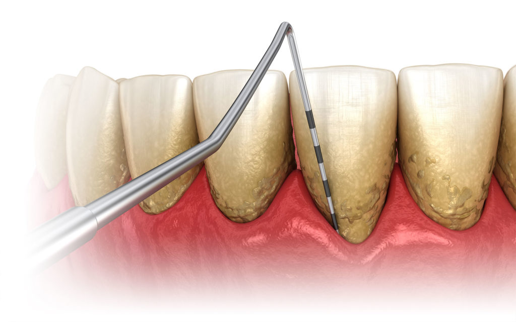 Dental Probing