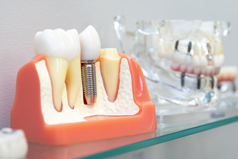 a model of a placed dental implant