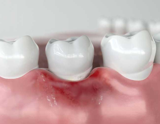 a model portraying receding gums