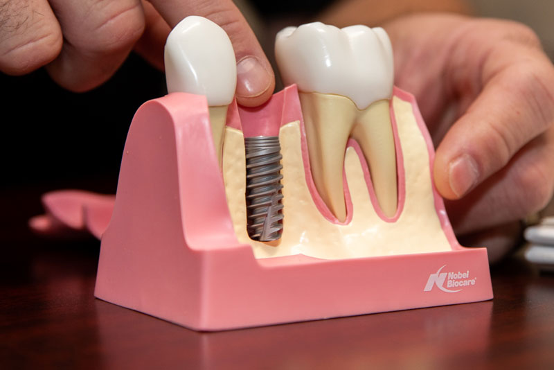 Dental Implant Model