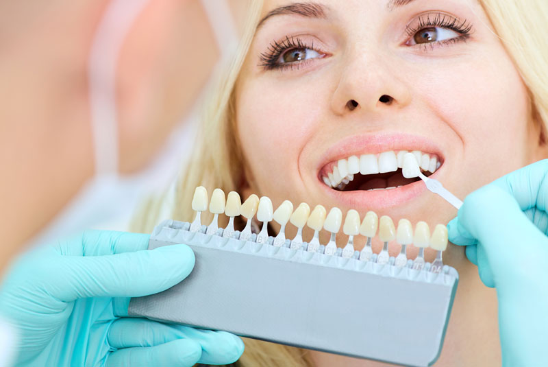 Dental Veneer Patient