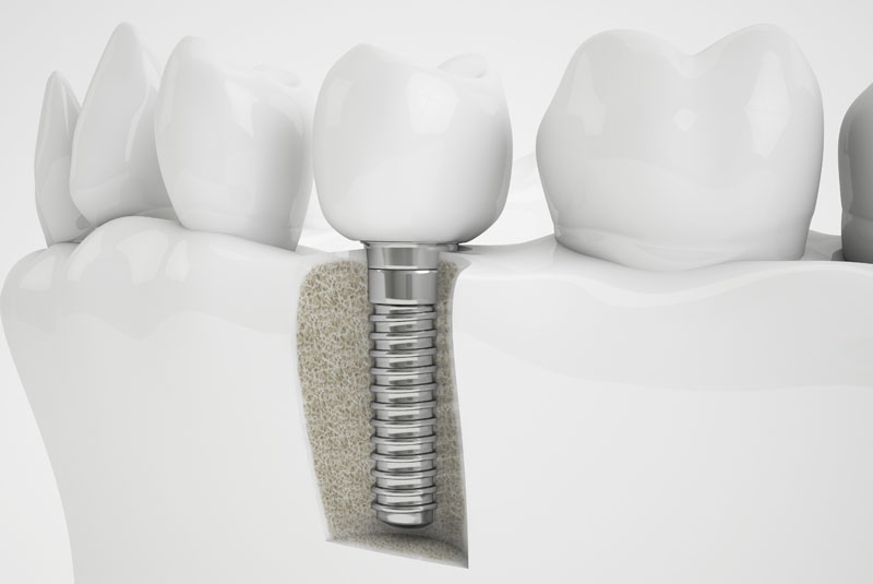 Bone Grafting Holding In A Dental Implant