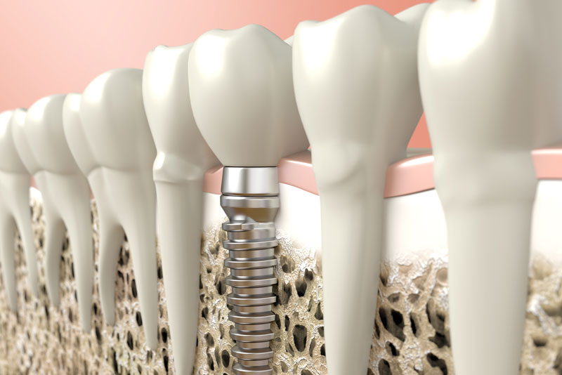 Dental Implant In Jawbone, Surrounded By Natural Teeth