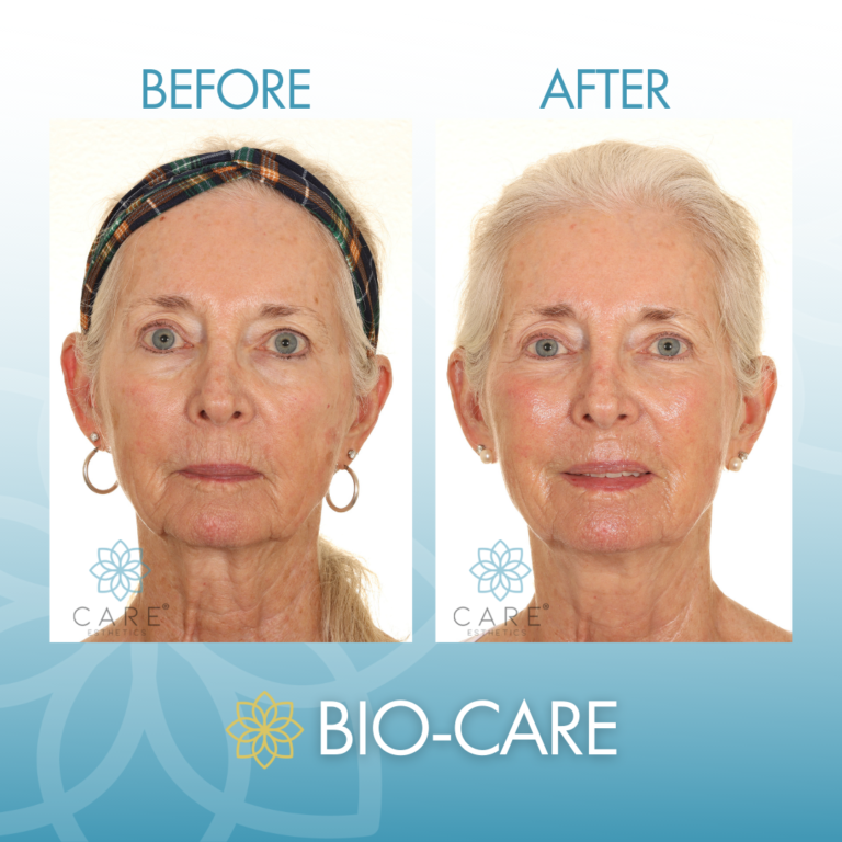 Bio CARE Signature Treatment Results