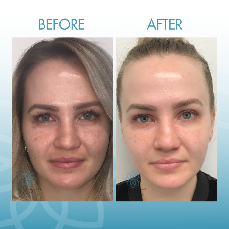 Bio Lift Signature Treatment Results