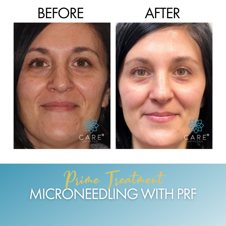 Microneedling with PRF Results