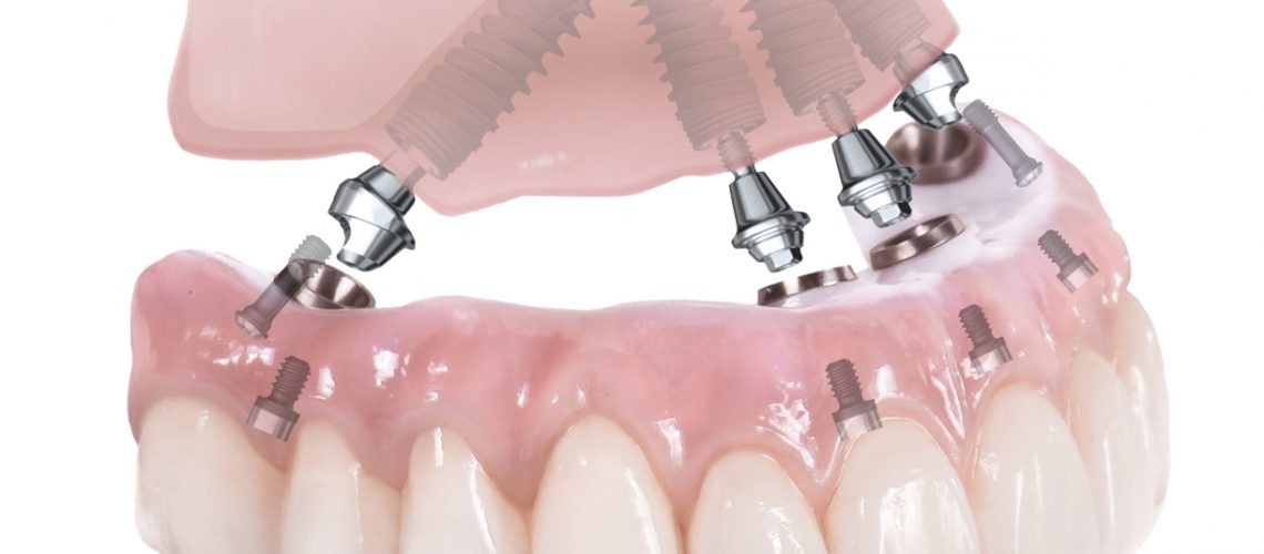 All-On-4-Dental-Implants