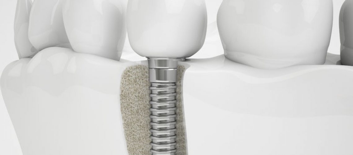 Bone Grafting Holding In A Dental Implant