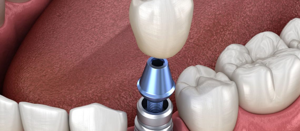 dental-implant-model 2
