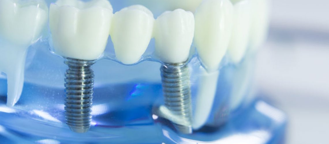 Dental Implant Model