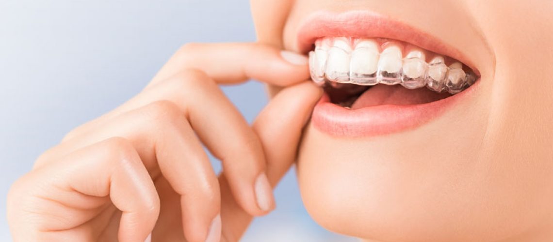Dental Patient Wearing Invisalign Retainers